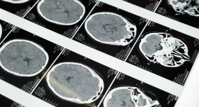 Travmatik Beyin Hasarlarında GörülenPsikopatolojik Sorunlar